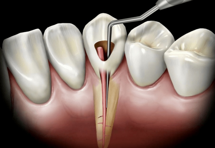 Lječenje kanala korena zuba