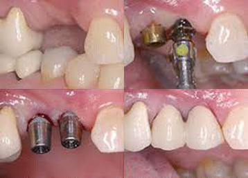 Krunice i mostovi na zubnim implantima