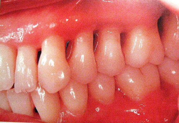 Lječenje kanala korena zuba